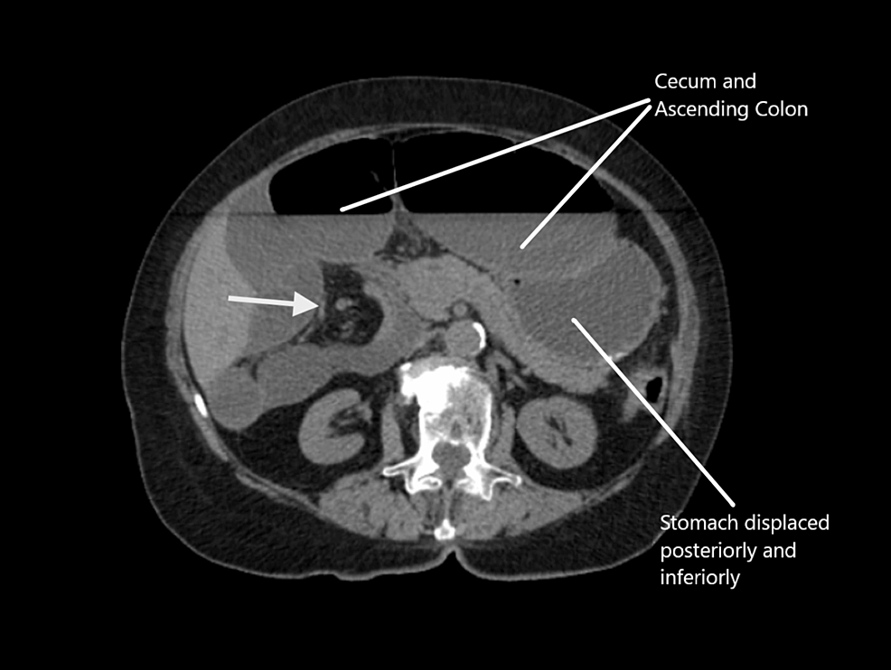 -CT-abdomen-and-pelvis-without-contrast.-Whirl-sign-displaying-cecal-volvulus-(arrowhead).
