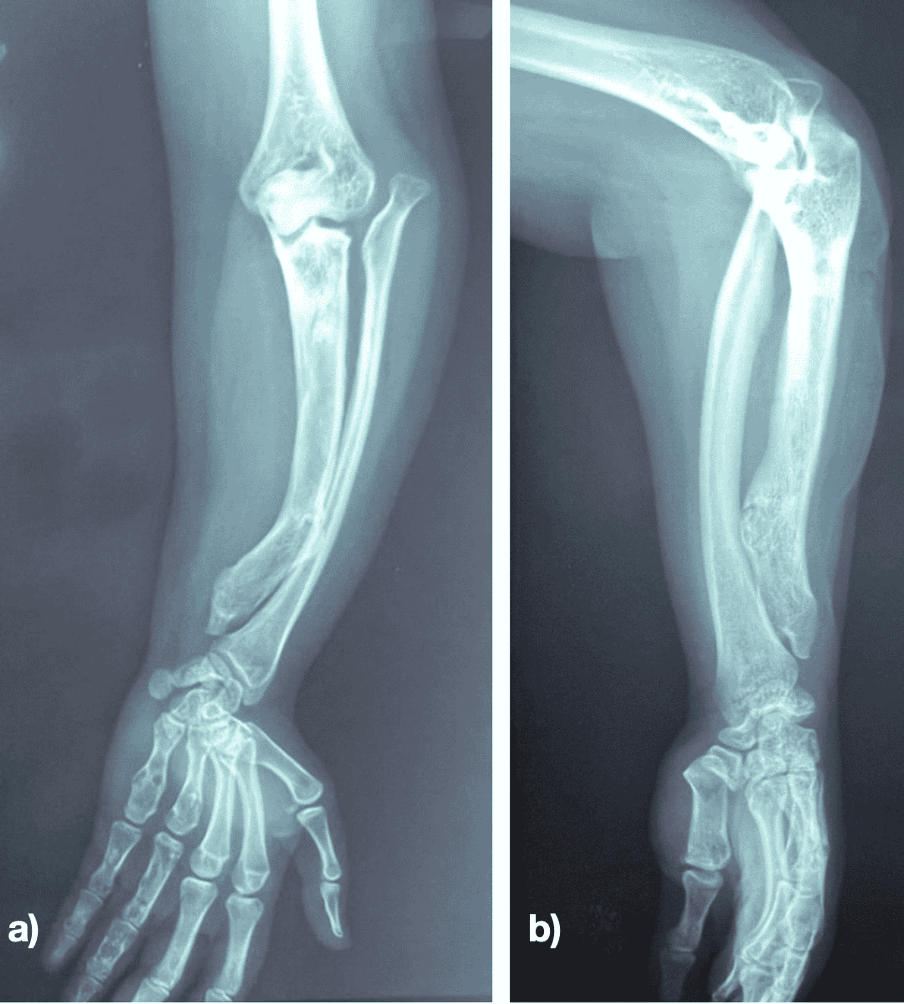 Modified Technique Of Single Bone Forearm In The Treatment Of   Lightbox B0bad700ddfa11ecbc0d1357a905da29 Capture D Ecran 2022 05 27 A 21.21.54 