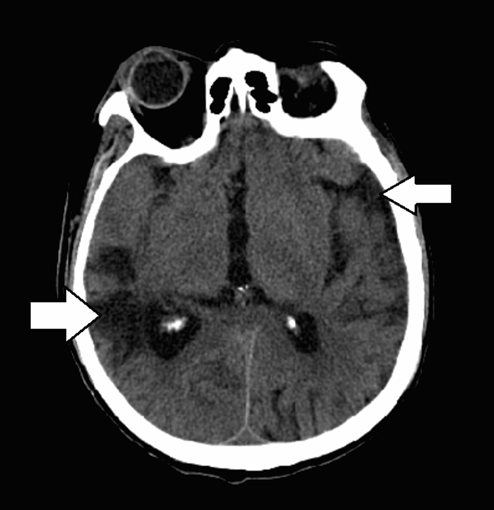 CT-scan-of-the-head-without-contrast-showing-diffuse-encephalomalacia-(white-arrows).