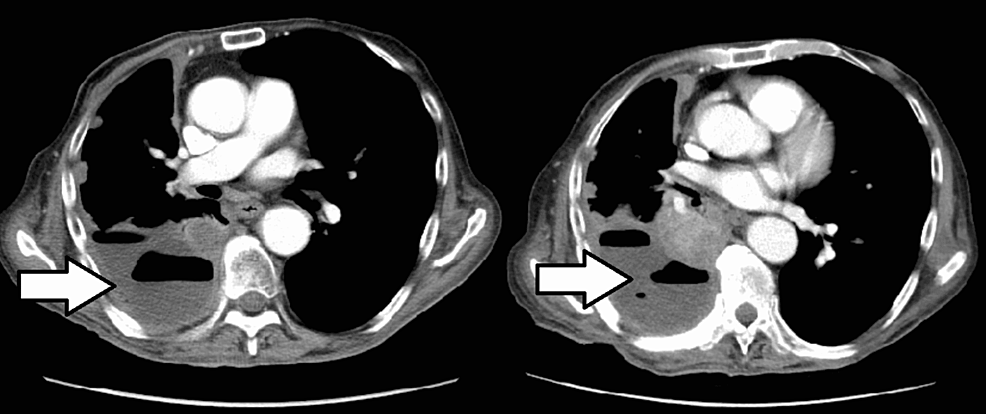 CT-scan-of-the-chest-(left)-showing-pleural-effusion-(white-arrow),-unchanged-from-the-prior-CT-scan-of-the-chest-(right).