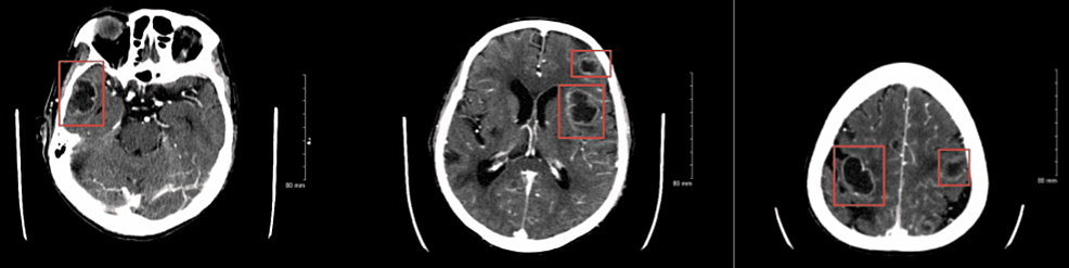 CT-scan-of-the-head-with-contrast-showing-multiple-ring-enhancing-lesions-suggestive-of-neoplasm/malignancy.