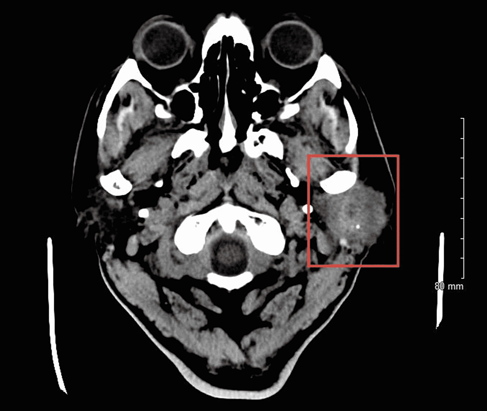 CT-soft-tissue-neck-with-contrast-showing-salivary-gland-tumor-centered-within-the-left-parotid-gland-with-stranding-of-the-surrounding-subcutaneous-tissues-including-the-preauricular-area-as-well-as-inflammatory-changes-extending-toward the-cartilaginous-segment-of-the-left-external-auditory-canal-with-associated-narrowing.