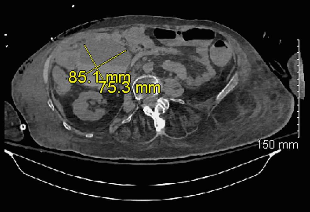 Focal-right-sided-peritoneal-hematoma measuring-85.1-x-75.3-mm-and-appearing-slightly-smaller