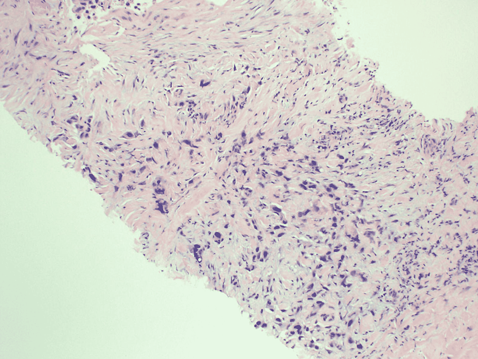 Pleural-biopsy showing-poorly-differentiated-epithelial-cells-infiltrate-fibrotic-pleural-tissue.-Tumor-cells-are-positive-for-p40-and-BER-EP4.-Findings-are-consistent-with-squamous-cell-carcinoma.