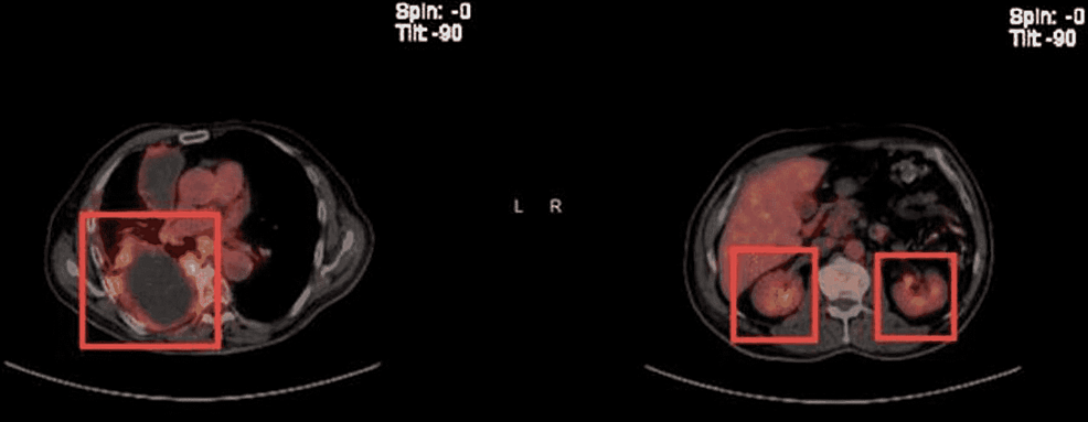 Positron-emission-tomography-scan-showing-metabolically-active-foci-in-localizing-to-right-lower-lobe-atelectasis-and-bilateral-adrenal-glands-indicating-neoplasm/malignancy.
