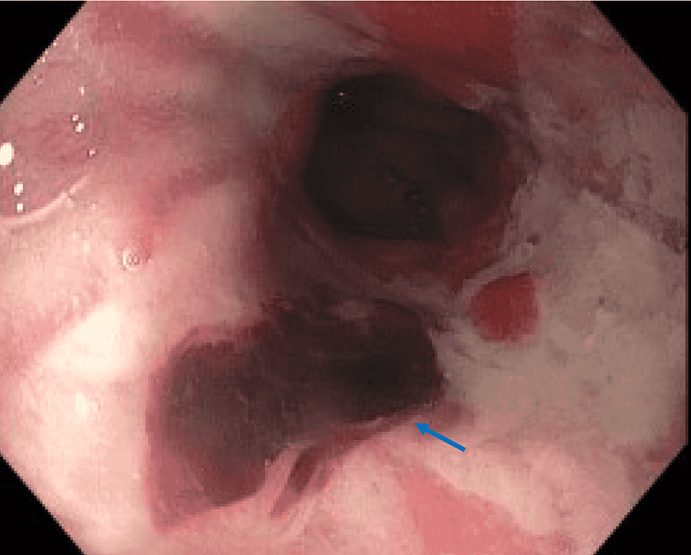 La unión gastroesofágica en la esofagogastroduodenoscopia muestra un desgarro de Mallory Weiss con un coágulo adherido (flecha azul)