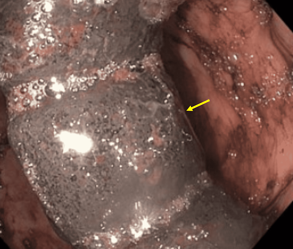 Banda gástrica (flecha amarilla) visualizada en la luz del estómago en la esofagogastroduodenoscopia (EGD)