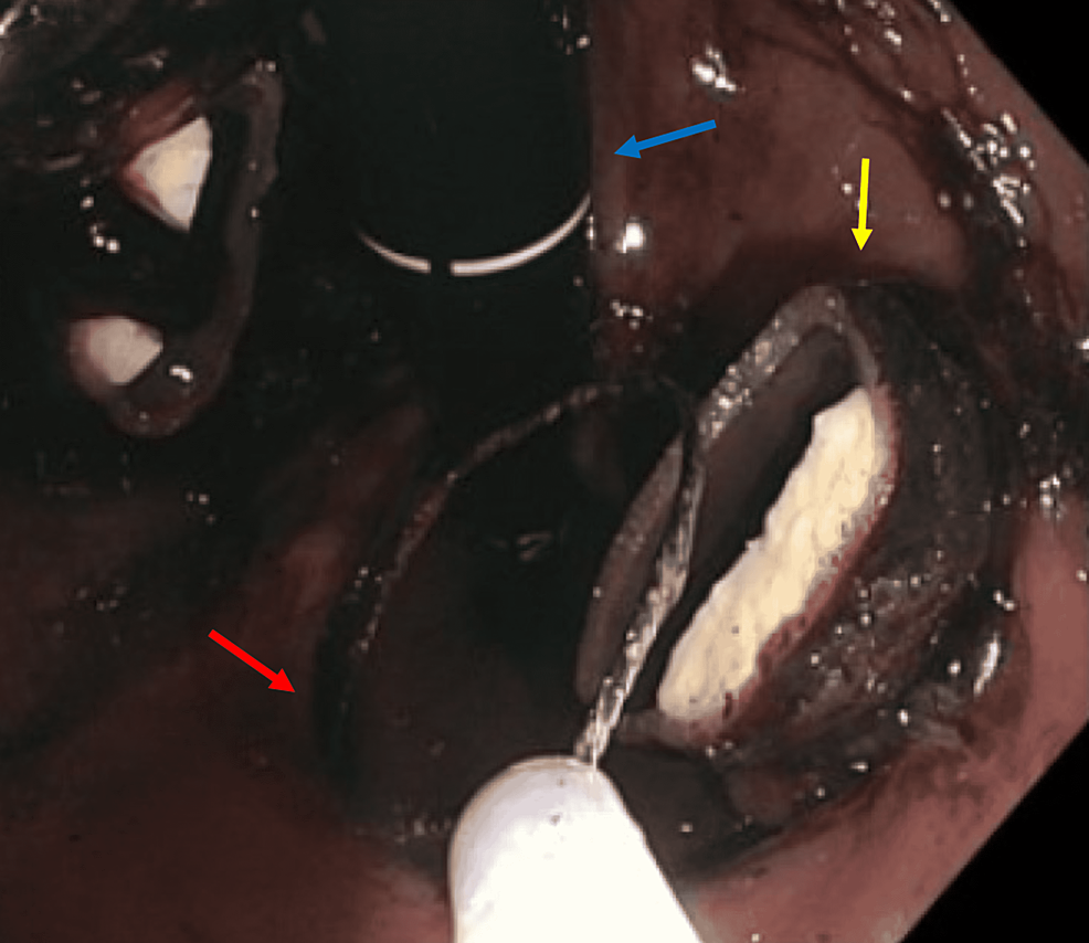 Banda gástrica seccionada (flecha amarilla) con el asa (flecha roja) vista en esofagogastroduodenoscopia EGD (alcance---flecha azul)