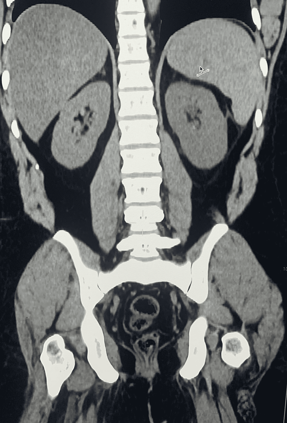 CT-scan-of-abdomen-(coronal-view-without-contrast)-shows:-liver-is-enlarged-with-diffuse-fatty-infiltration;-gallbladder-is-normal-without-any-intraluminal-calculus;-adrenals-and-pancreas-are-unremarkable;-spleen-is-enlarged-and-measures-26-cm-with-homogenous-texture.