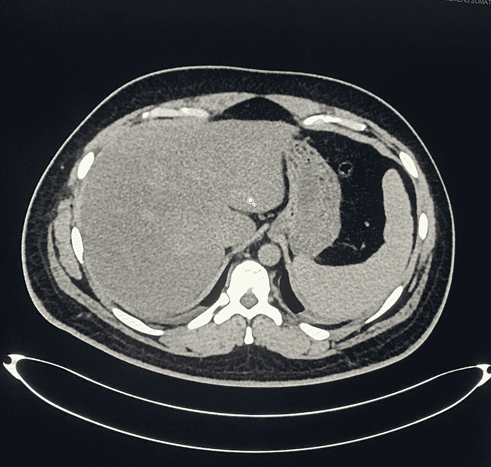 CT-scan-of-abdomen-(axial-view-without-contrast).