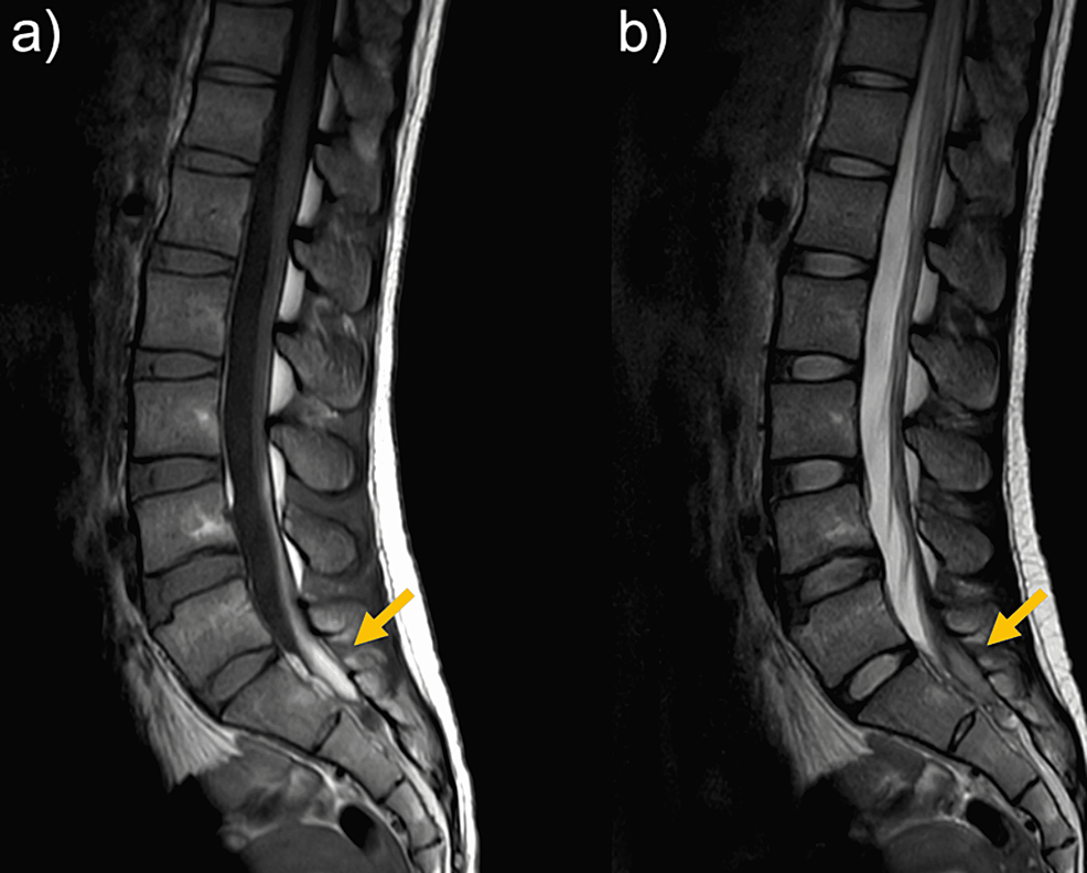 Lumber-MRI-at-seven-days-after-left-leg-pain-appeared