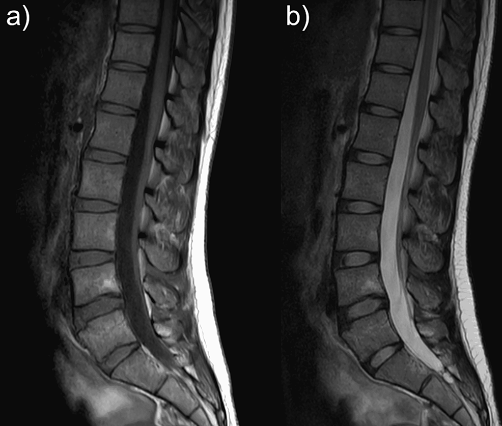 MRI-at-six-months-after-onset