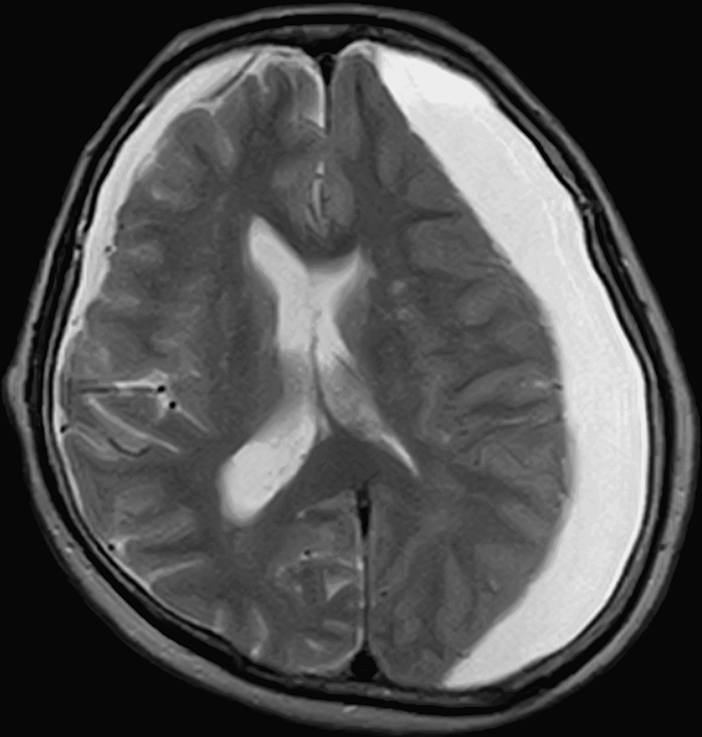 Brain-MRI-on-admission