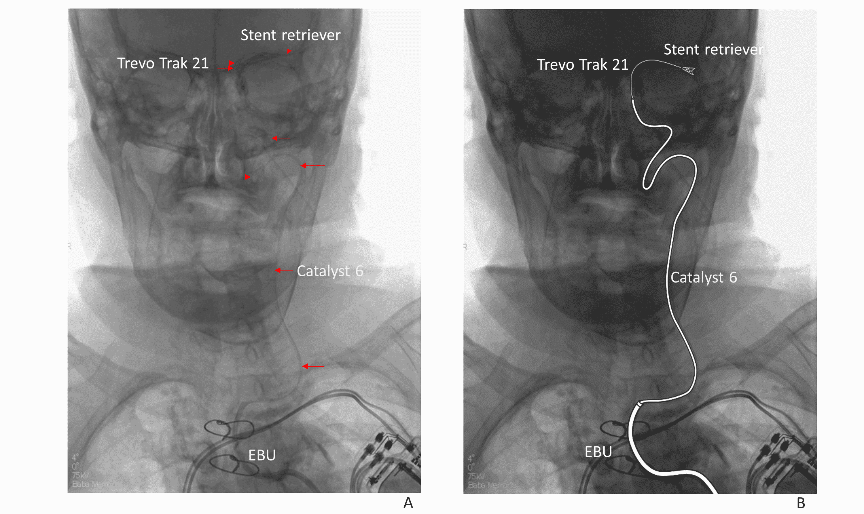 Cureus Clinical Experience of Using an 8 French Newton Shaped