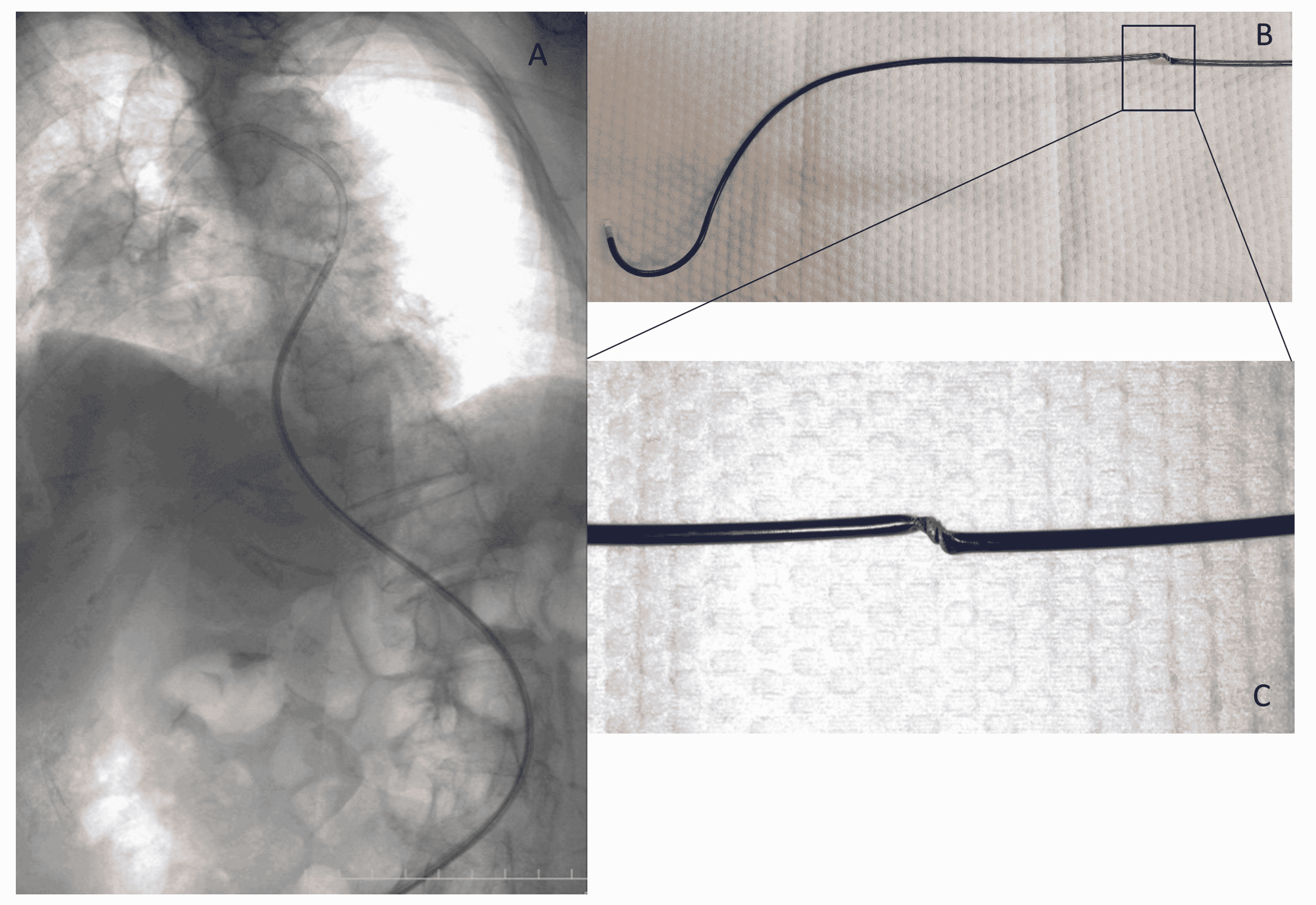 Cureus Clinical Experience of Using an 8 French Newton Shaped