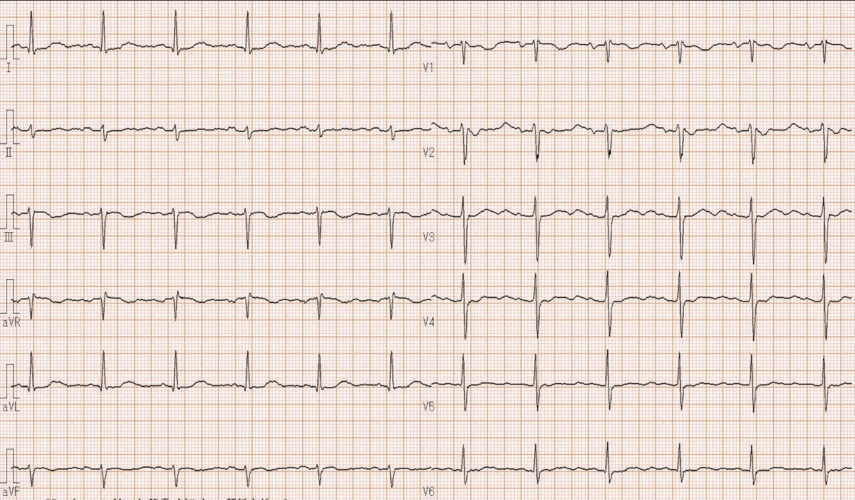 Cureus Severe Hypokalemia and Metabolic Alkalosis Caused by Licorice