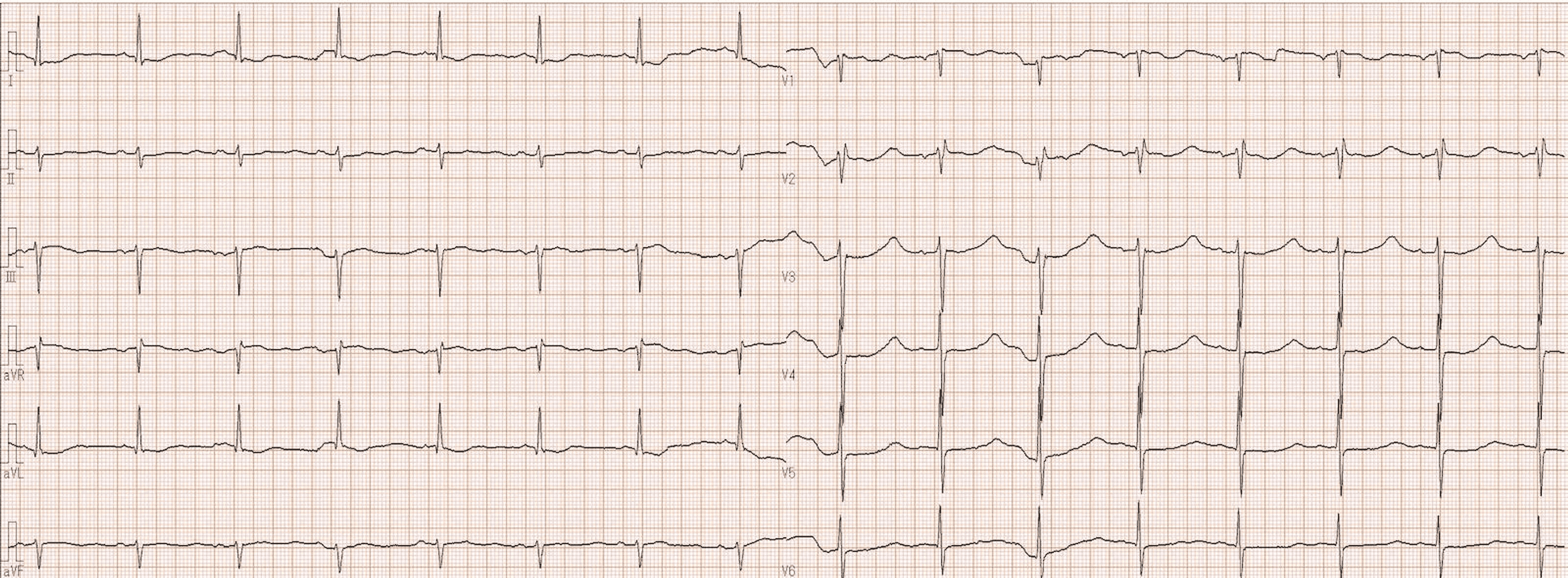 Cureus Severe Hypokalemia and Metabolic Alkalosis Caused by Licorice