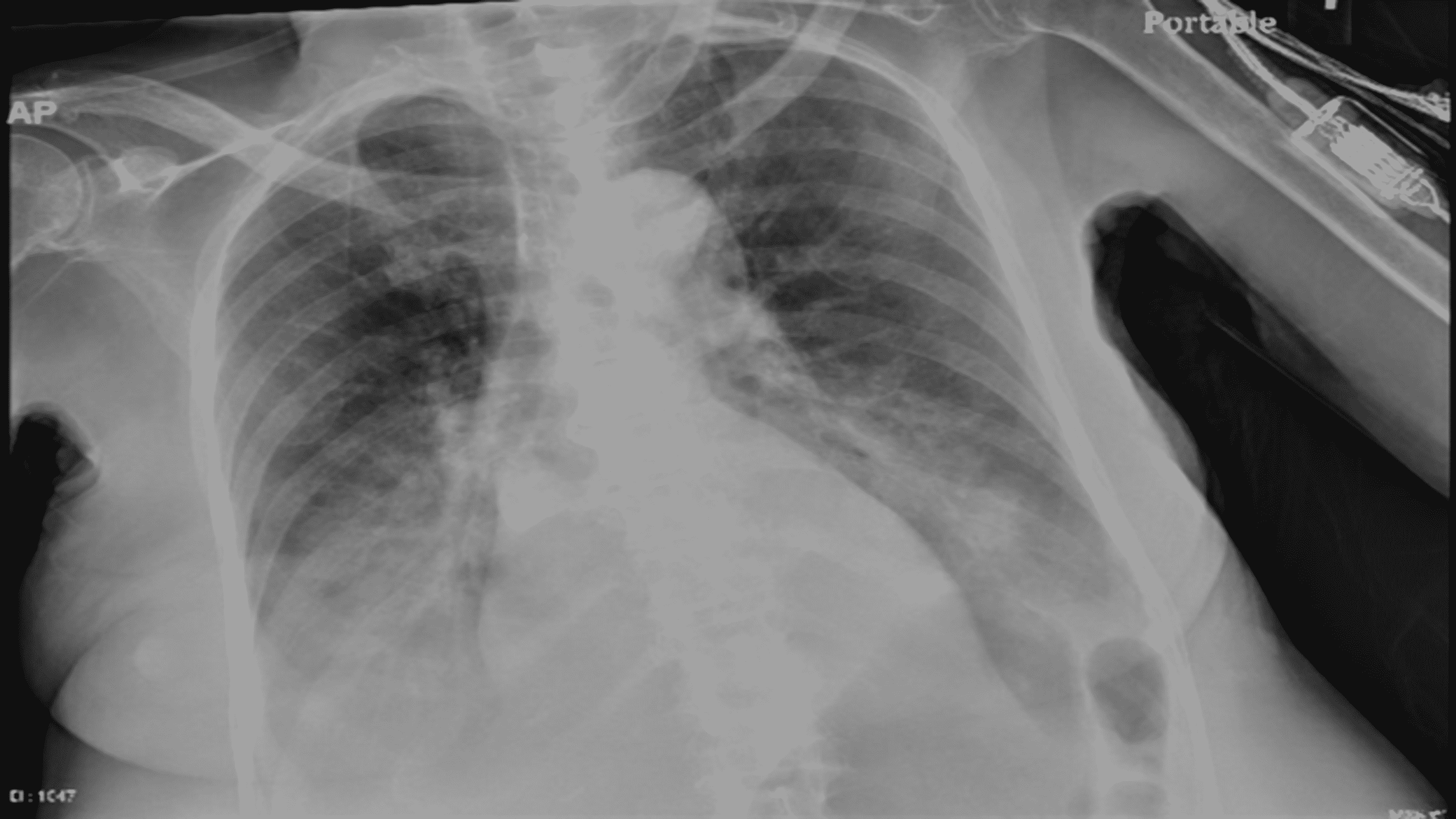 Cureus | Subclinical Hypothyroidism Presenting as Myxedema Coma: Case ...