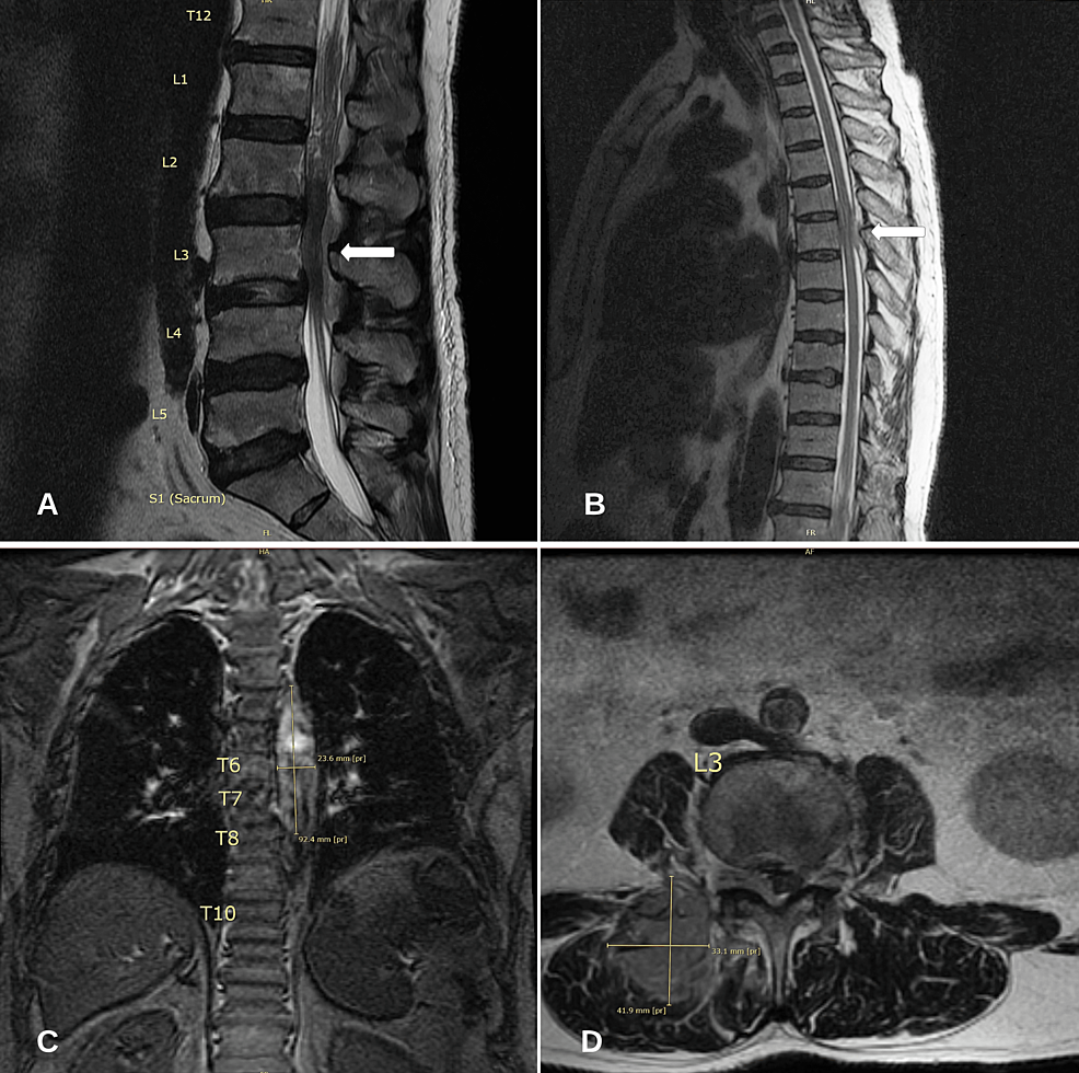Sporadic Burkitt Lymphoma of the Thoracic and Lumbar Spinal Canal