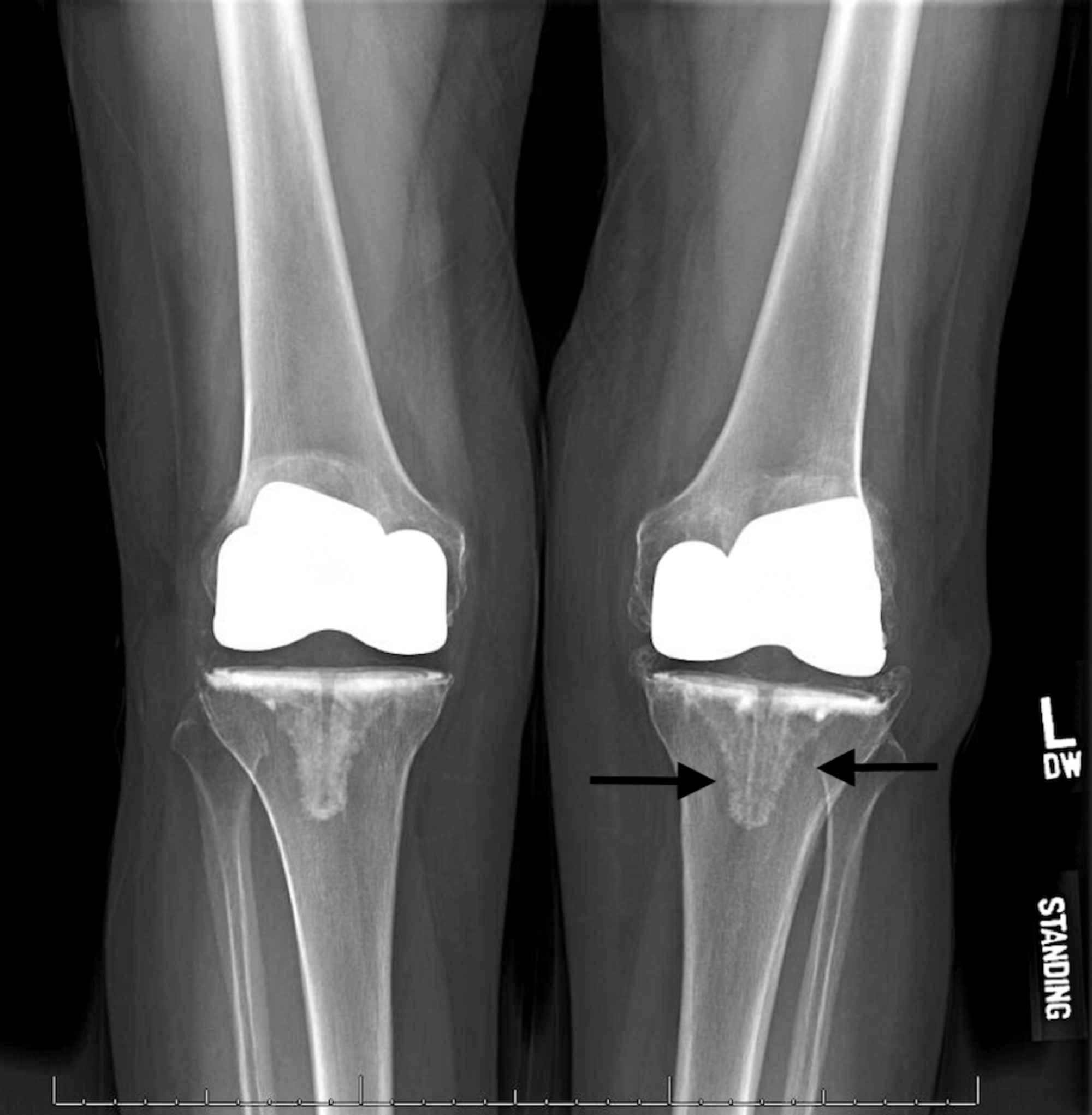 Cureus A Case Report Of Revision Total Knee Arthroplasty After Years All Grown Up What