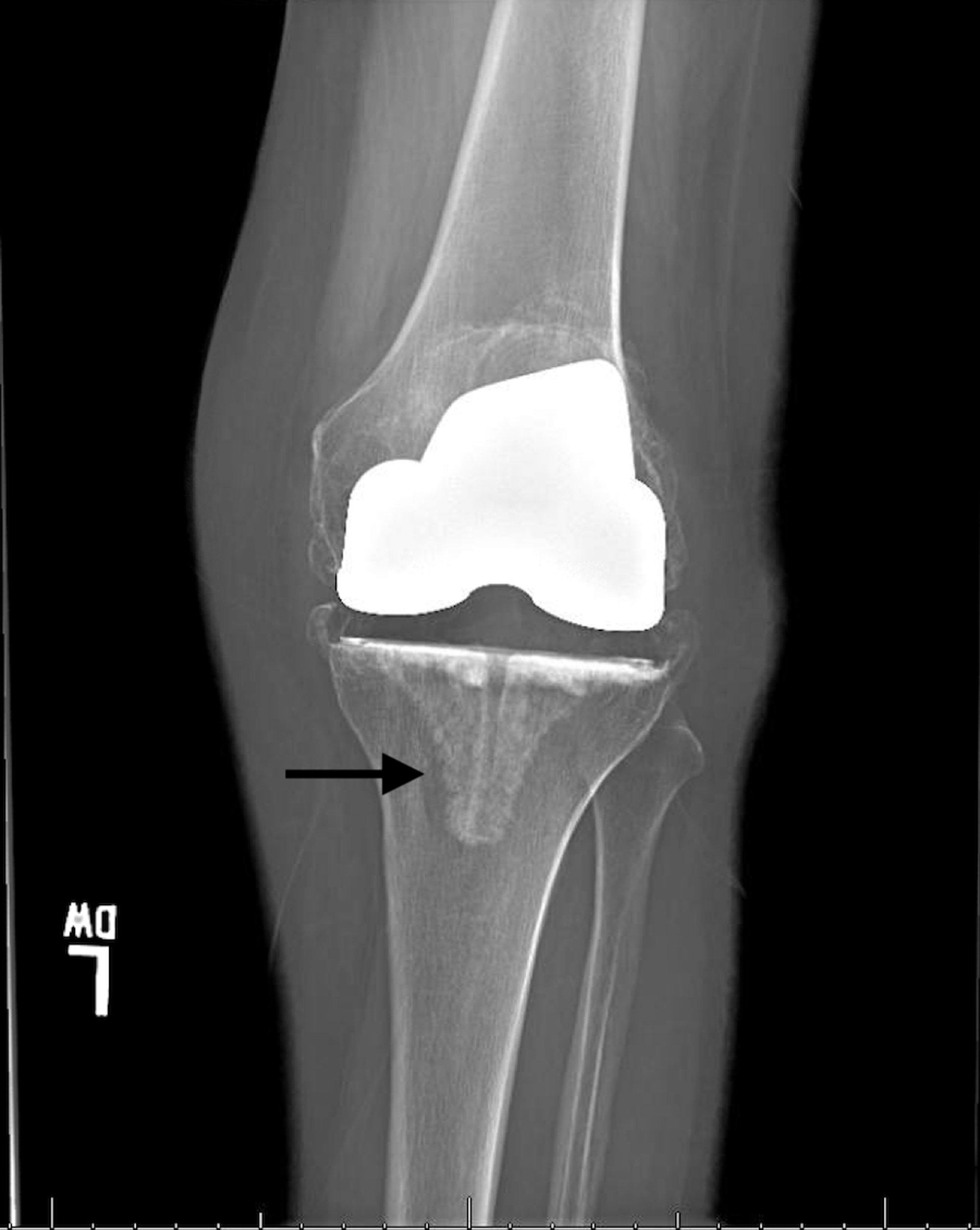 Cureus | A Case Report of Revision Total Knee Arthroplasty After 17 ...