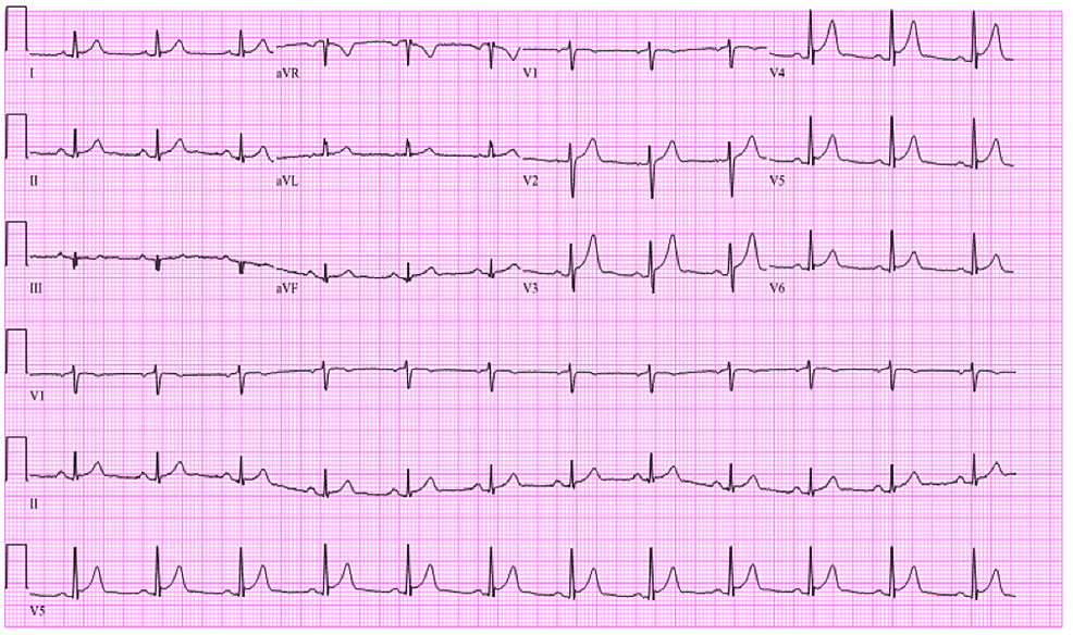 Initial-EKG-showing-ST-segment-elevations-in-V2-V4