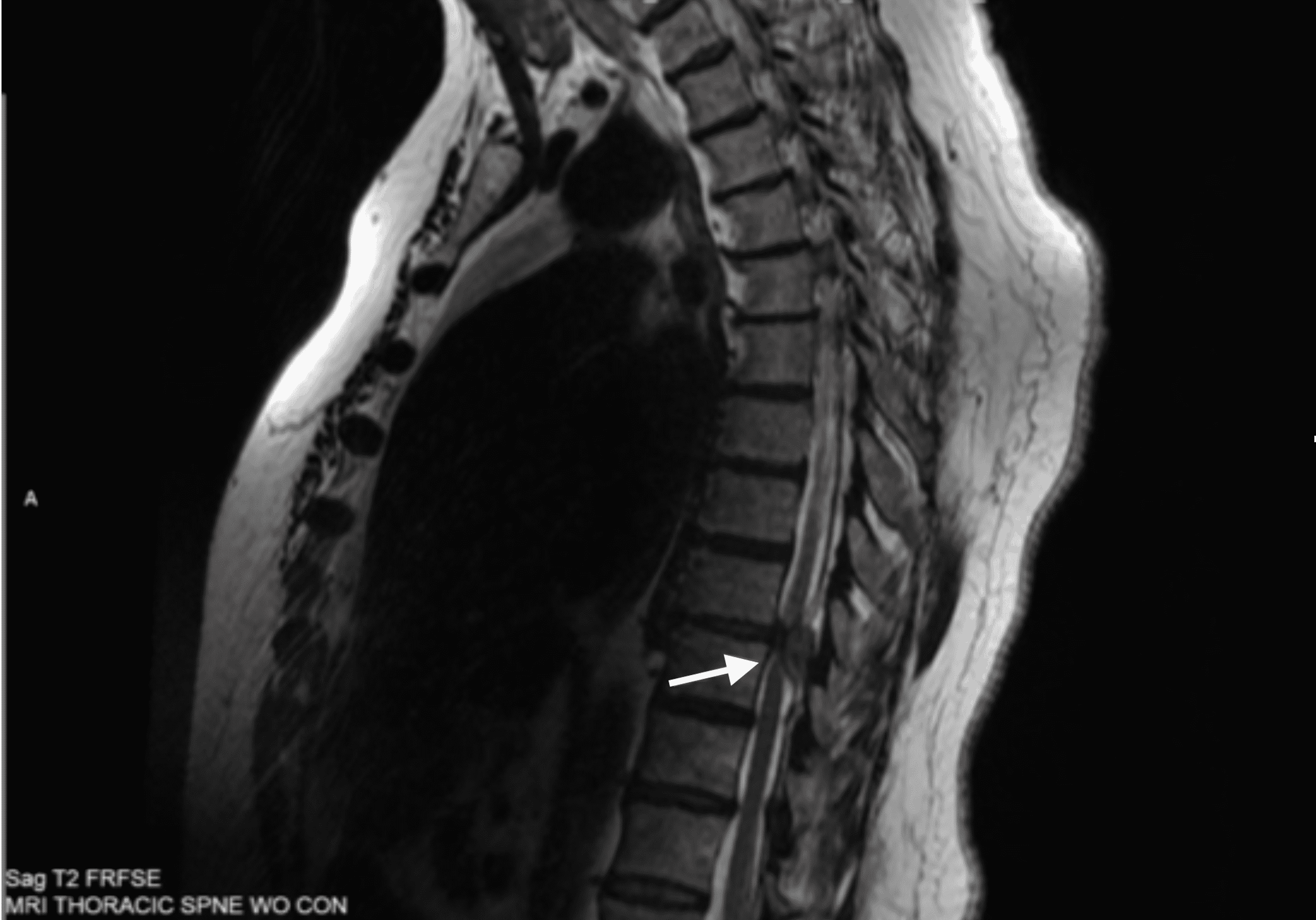 Cureus A Dorsal Epidural Herniated Disc Fragment Initially Presenting