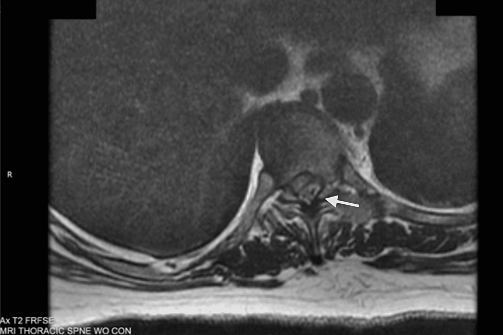 Cureus A Dorsal Epidural Herniated Disc Fragment Initially Presenting as GuillainBarré Syndrome
