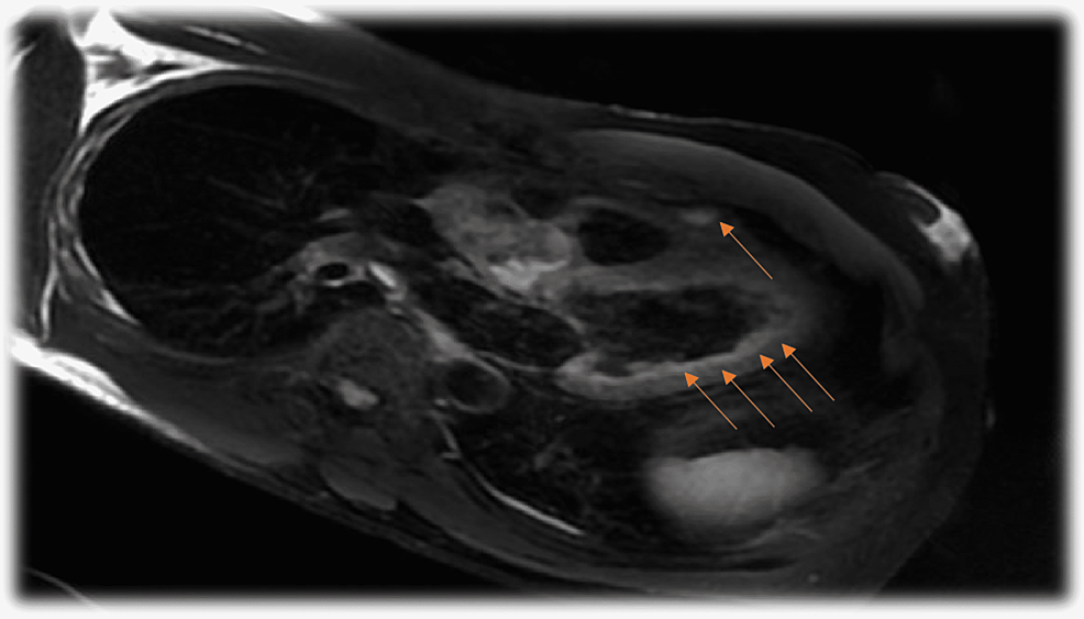 Cardiac-MRI-showing-multifocal-myocardial-late-gadolinium-enhancement-(arrows)-consistent-with-myocarditis-