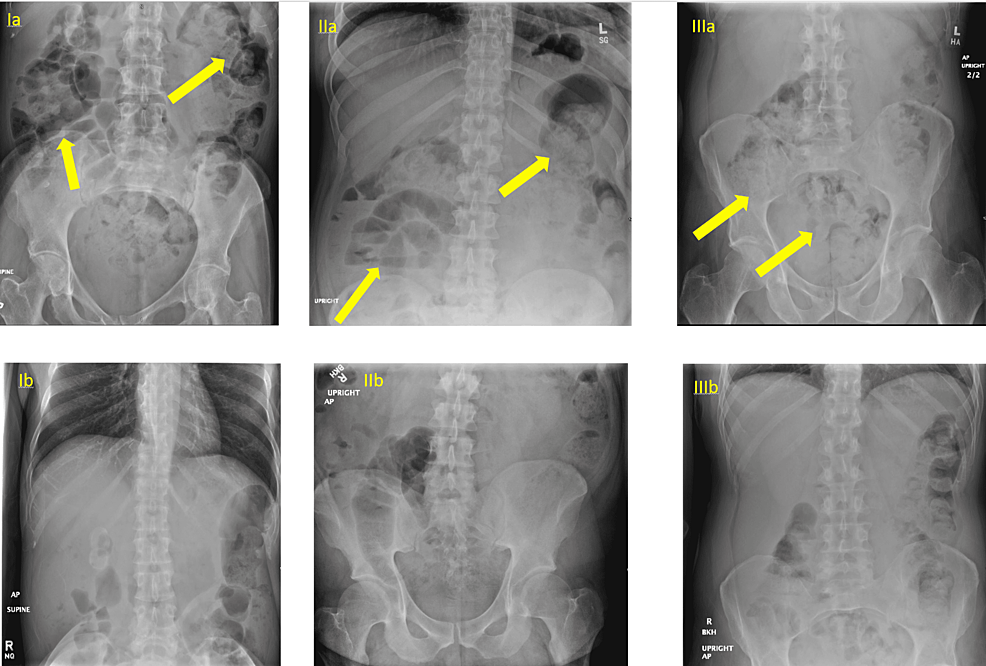 Abdominal-X-rays-of-cases-1-3