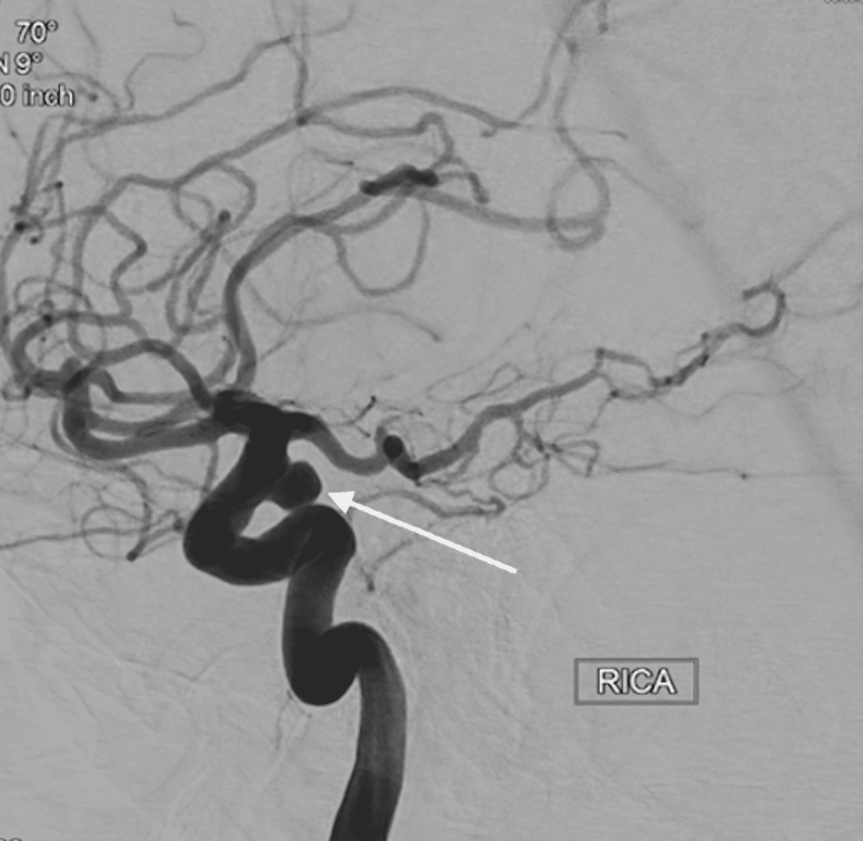 Cureus Ultra Short Term Dual Antiplatelet Therapy In Treating