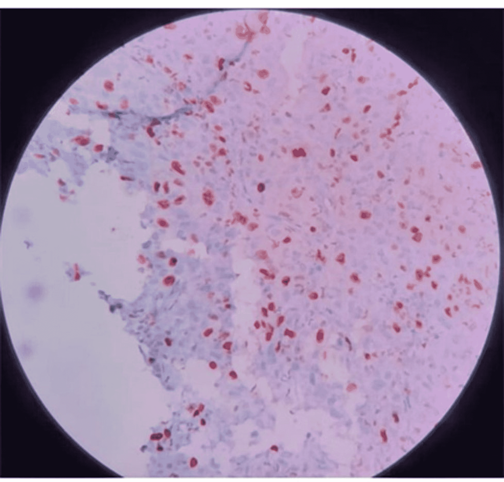 -Histiocytic-cells-with-high-MIB%.