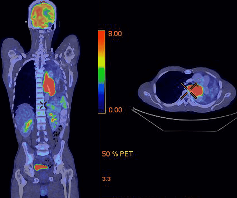 Pre-treatment-PET-CT-scan-showing-localized,-unresectable-lower-thoracic-esophageal-mass