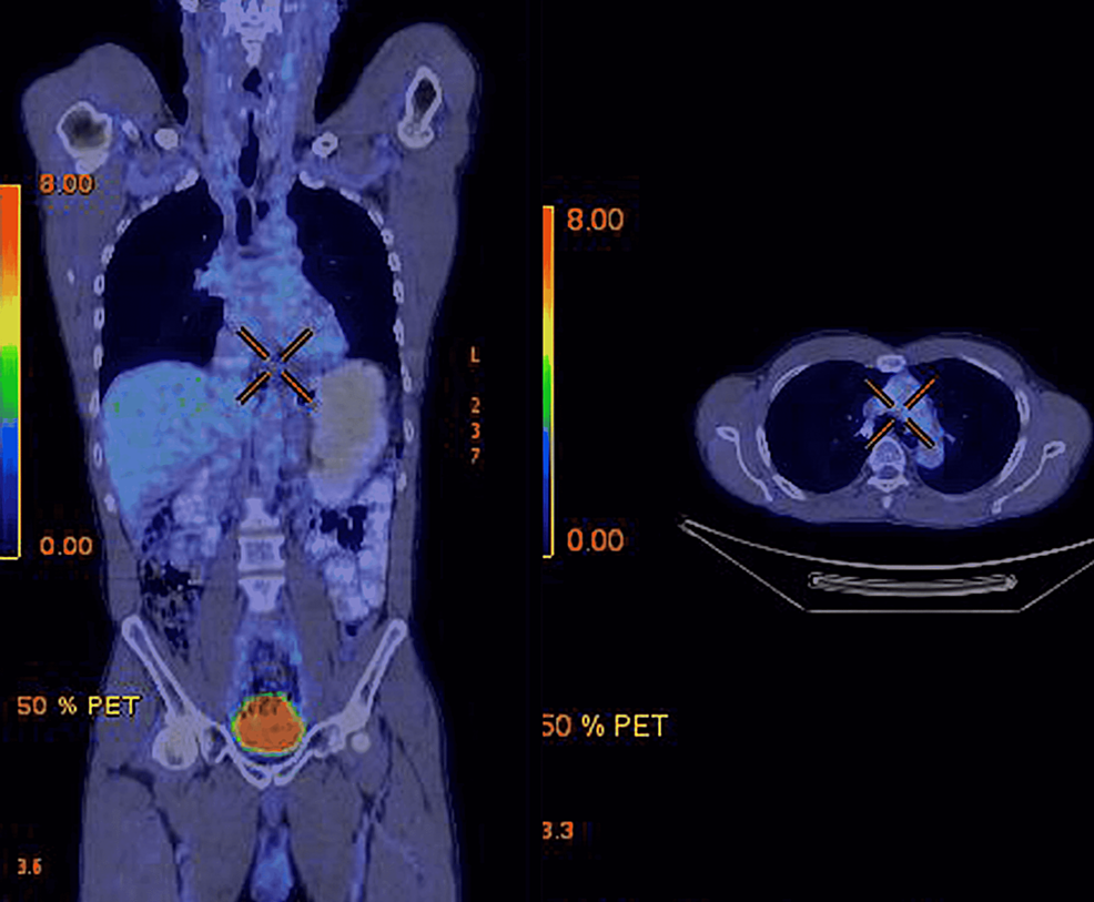 Post-treatment-PET-CT-scan-showing-complete-metabolic-response