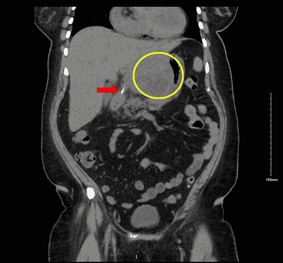 Cureus, A Rare Case of an Exploratory Laparotomy to Treat a Liver Abscess  Secondary to Foreign Body Ingestion