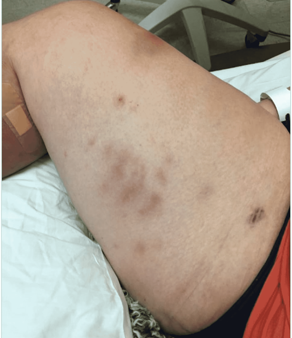 Photo-of-the-RLE-showing-cellulitis-upon-admission-for-the-patient's-second-hospital-stay.-Note-the-proximal-progression-of-the-lesions.