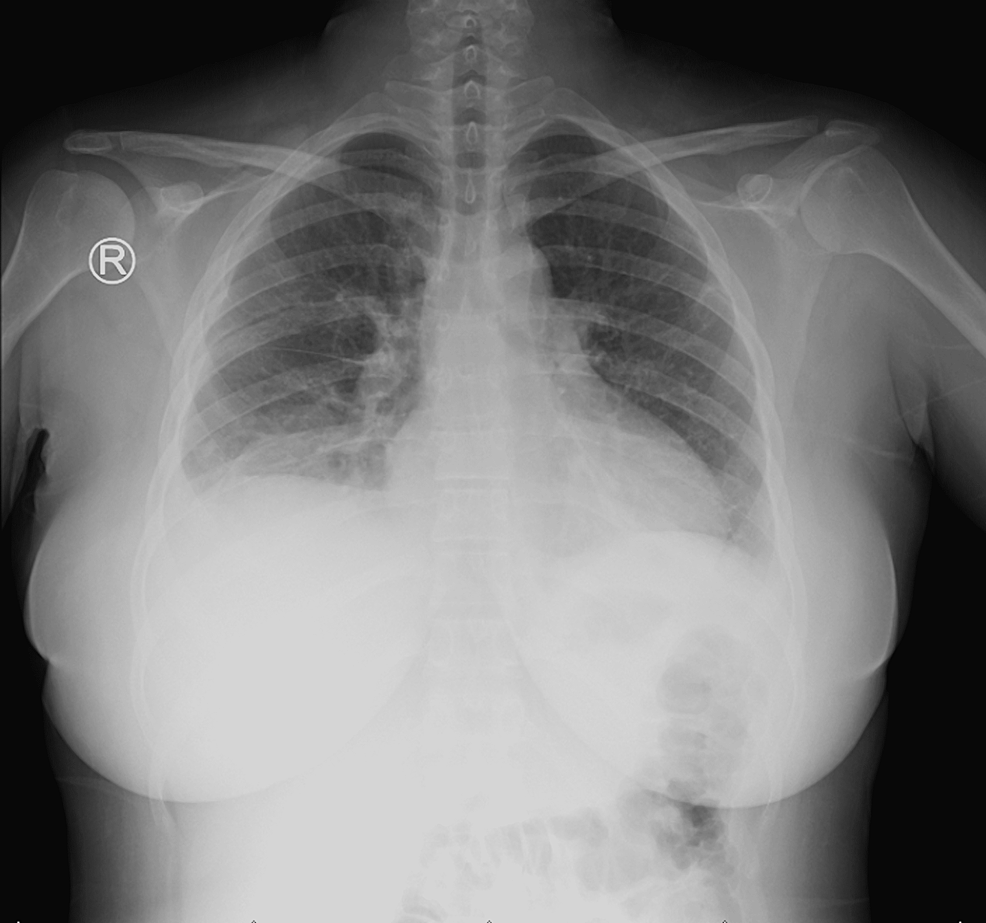 El gran imitador: embolia pulmonar que se presenta como dolor en el flanco en un paciente con enfermedad de células falciformes