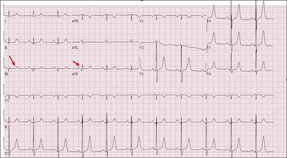 Treadmill Exercise Stress Test-Induced Takotsubo Cardiomyopathy: A Case ...