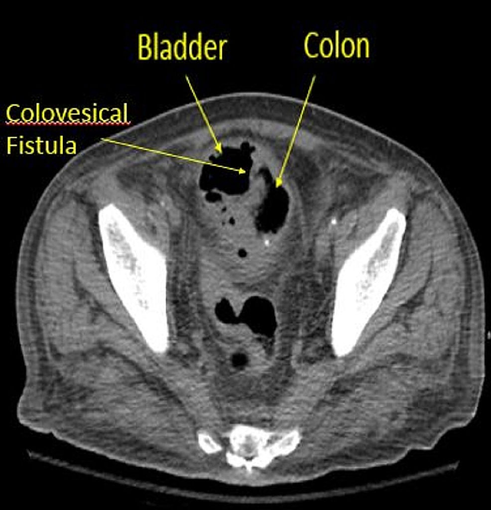 Colovesical Fistula As An Uncommon Presentation Of Metastatic Lung 