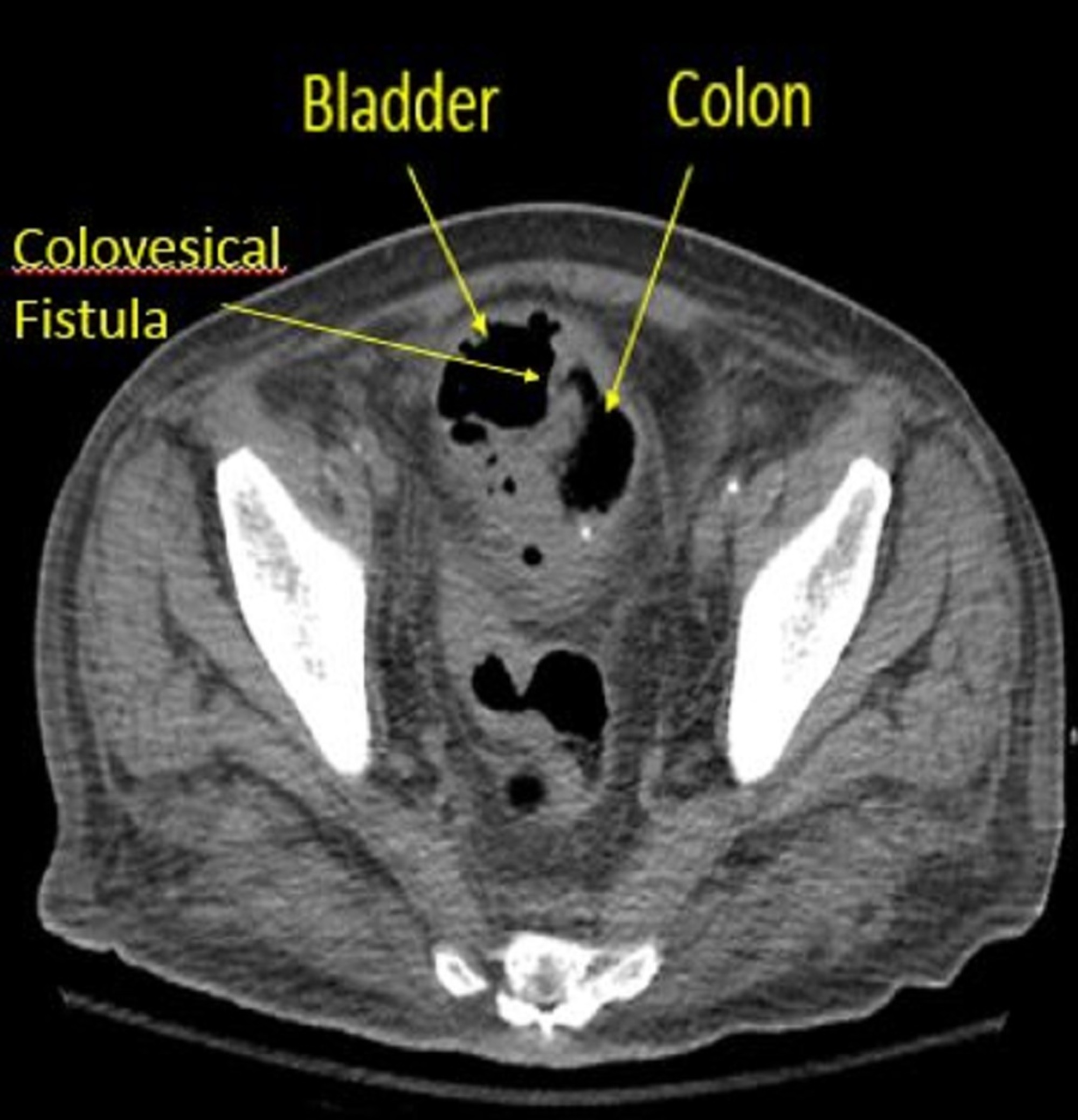 Cureus Colovesical Fistula As An Uncommon Presentation Of Metastatic 