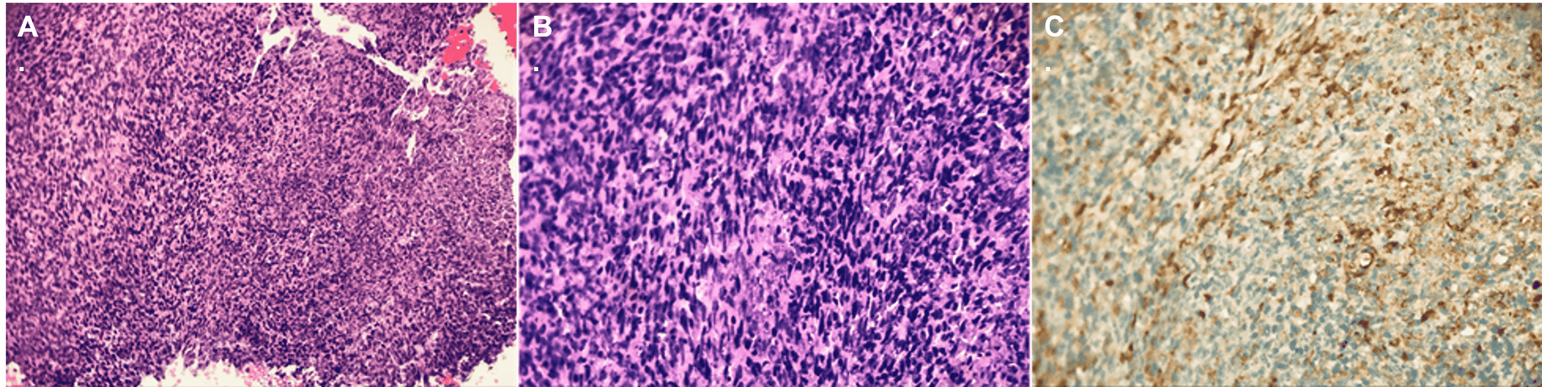 Cureus An Unexpected Transformation Malignant Spindle Cell Carcinoma Developed From Primary