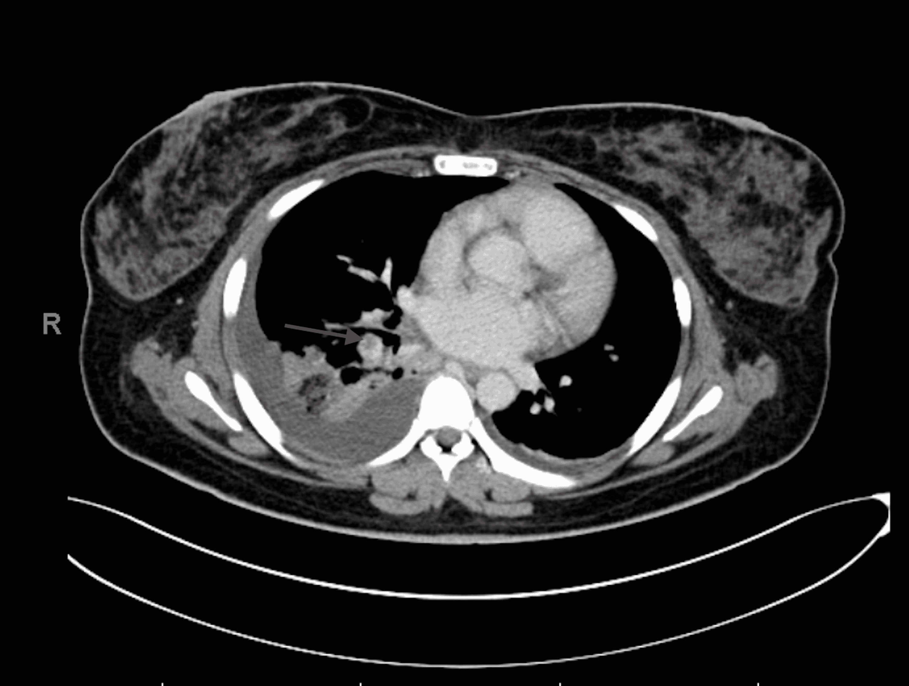 The Great Mimicker Pulmonary Embolism Presenting as Flank Pain in a