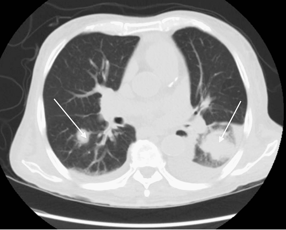 White-arrows-show-left-lower-lobe-infiltrate-and-right-lung-nodule-on-chest-CT.