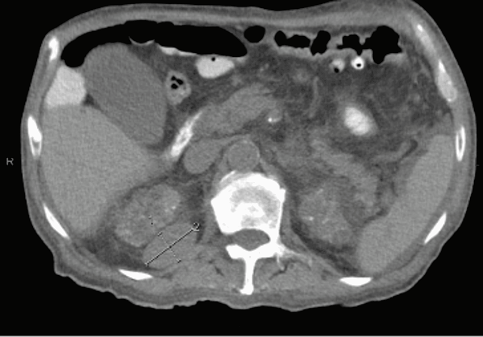CT-of-the-abdomen-demonstrating-a-4.1-cm-×-2.5-cm-left-retroperitoneal-nodule,-suspicious-for-a-metastatic-lesion.