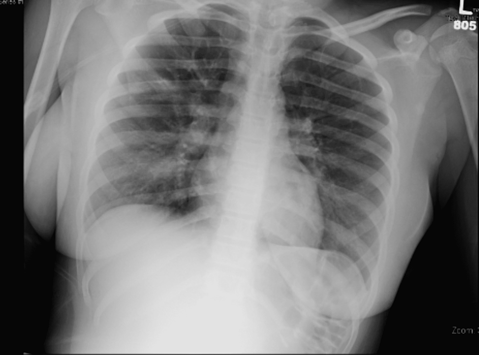 Chest-X-ray-demonstrating-no-acute-intra-thoracic-process.