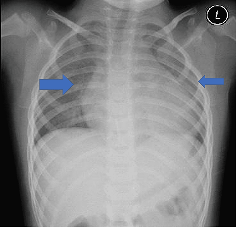 X-ray-shows-clear-lungs-fields-apart-from-the-bilateral-peribronchial-thickening-(blue-arrows).
