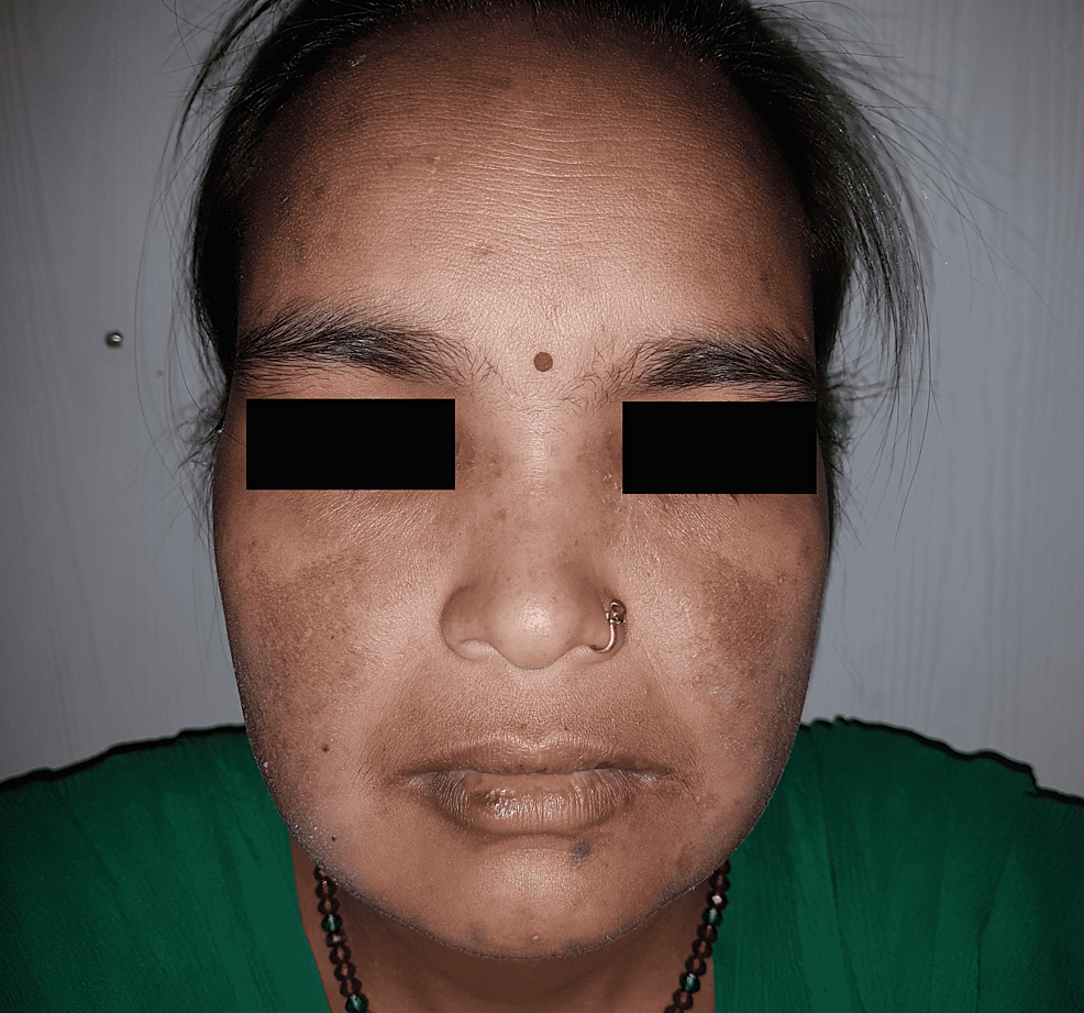 cureus-systemic-lupus-erythematosus-in-india-a-clinico-serological