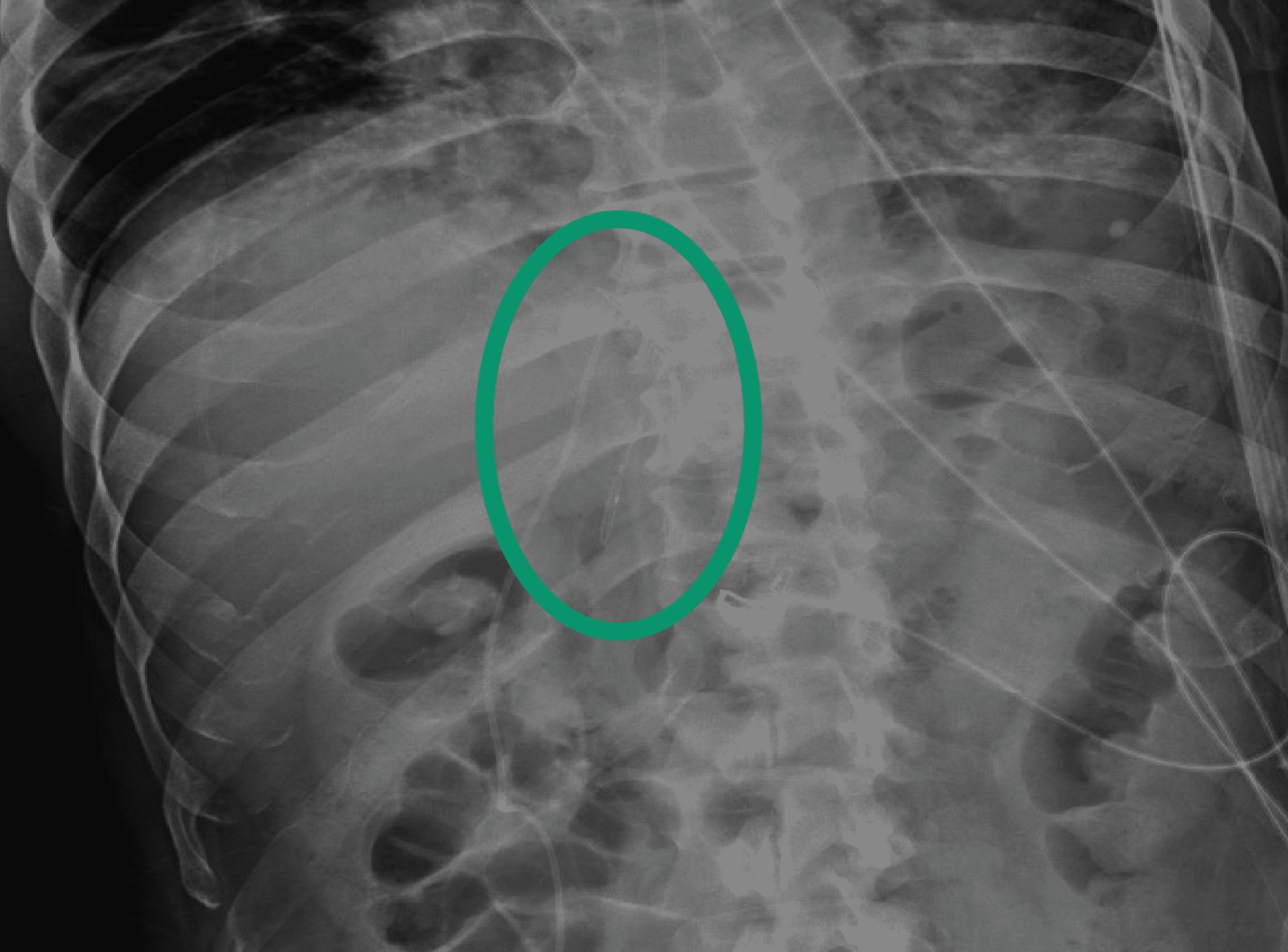 Cureus | Migration Of An Inferior Vena Cava (IVC) Filter Into The ...