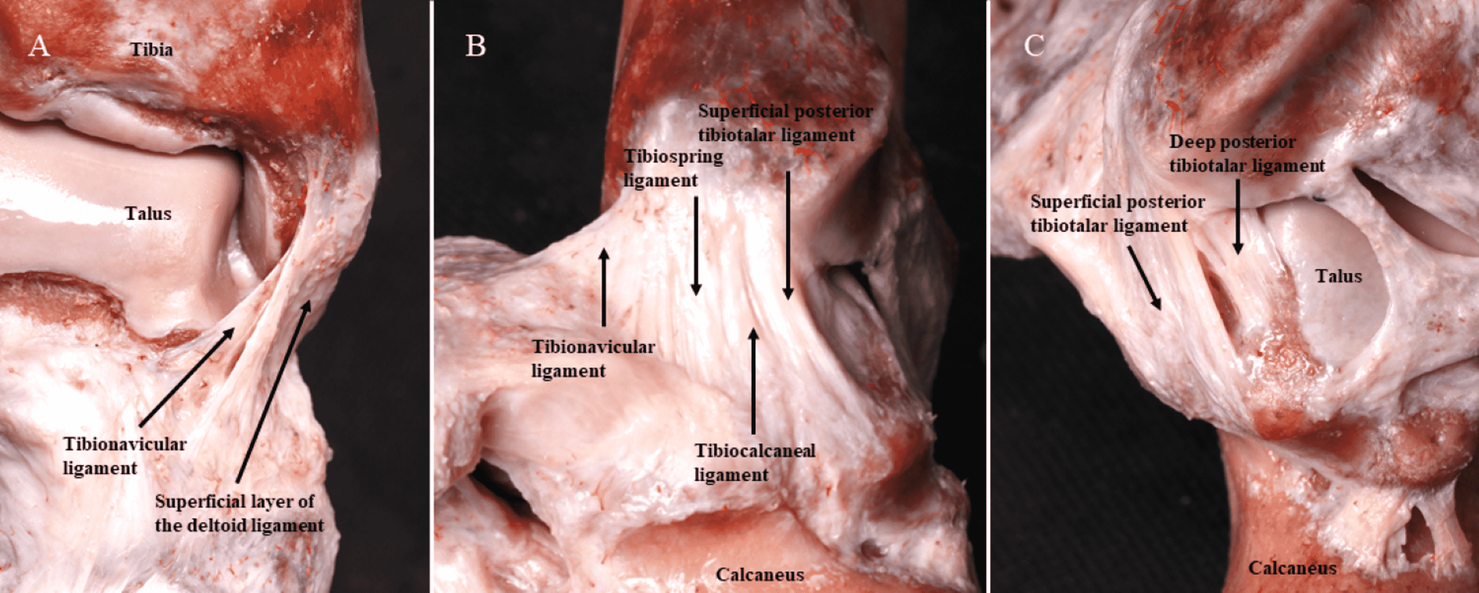 Cureus Assessing The Utility Of Deltoid Ligament Repair In Ankle Fracture A Systematic Review 0355