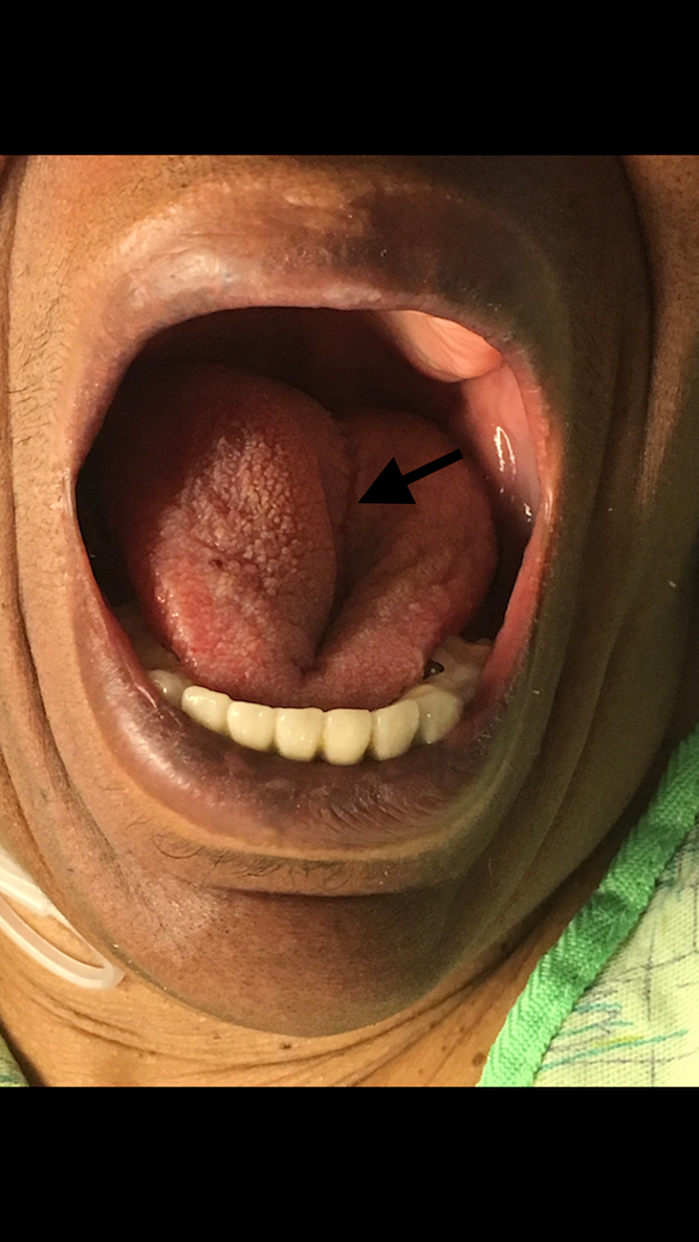 Right-sided-tongue-edema